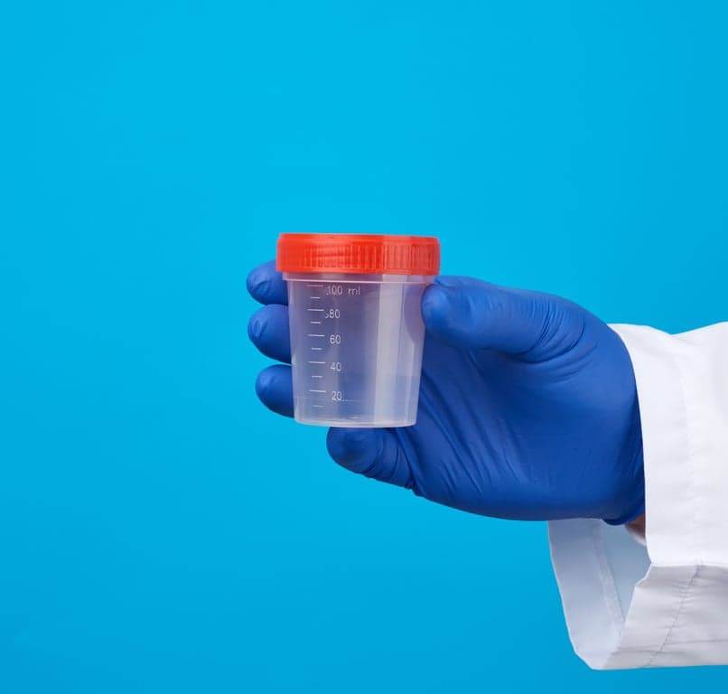 Laboratory stool sample tube labelled for a faecal calprotectin test with a report showing gut inflammation levels