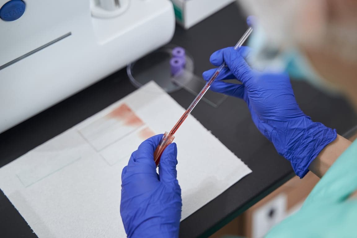Illustration of a blood sample tube labelled albumin with a liver and kidney representing protein synthesis and filtration