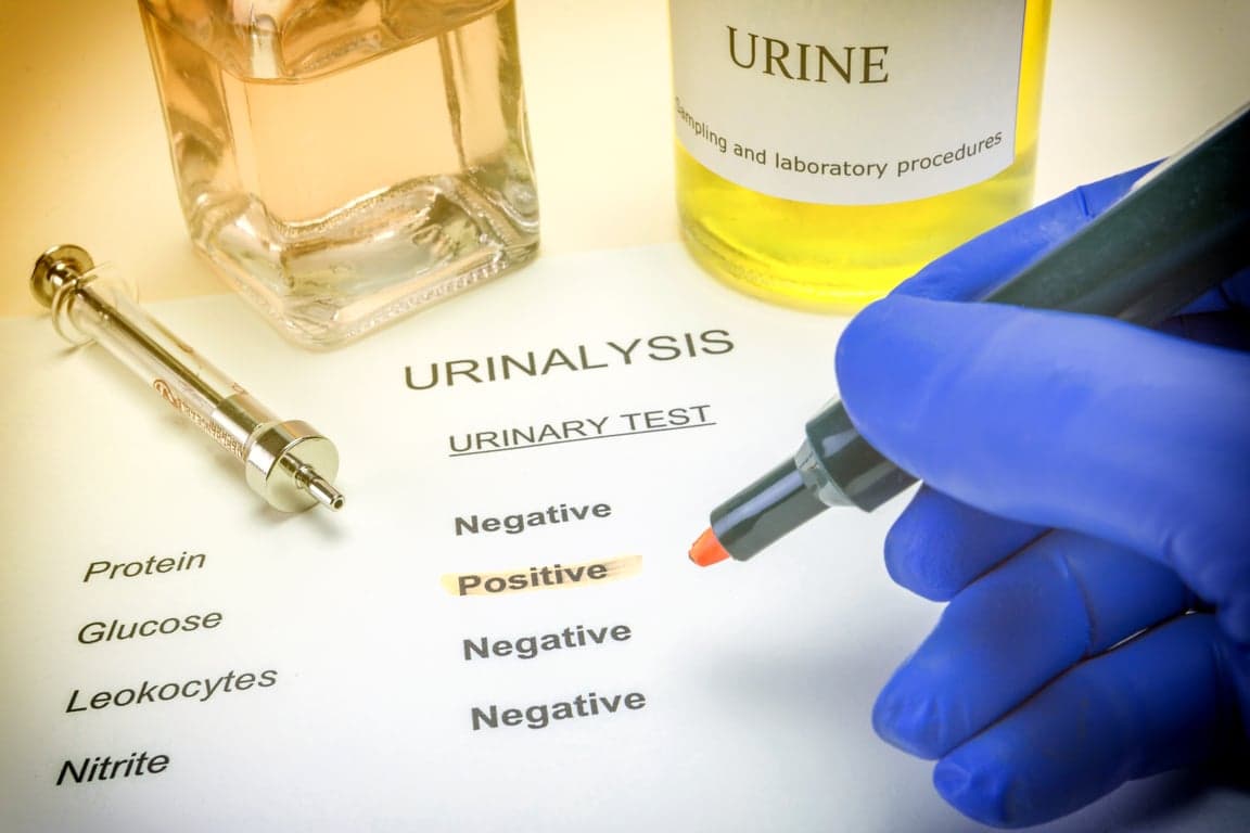 urinalysis test with positive result in medical